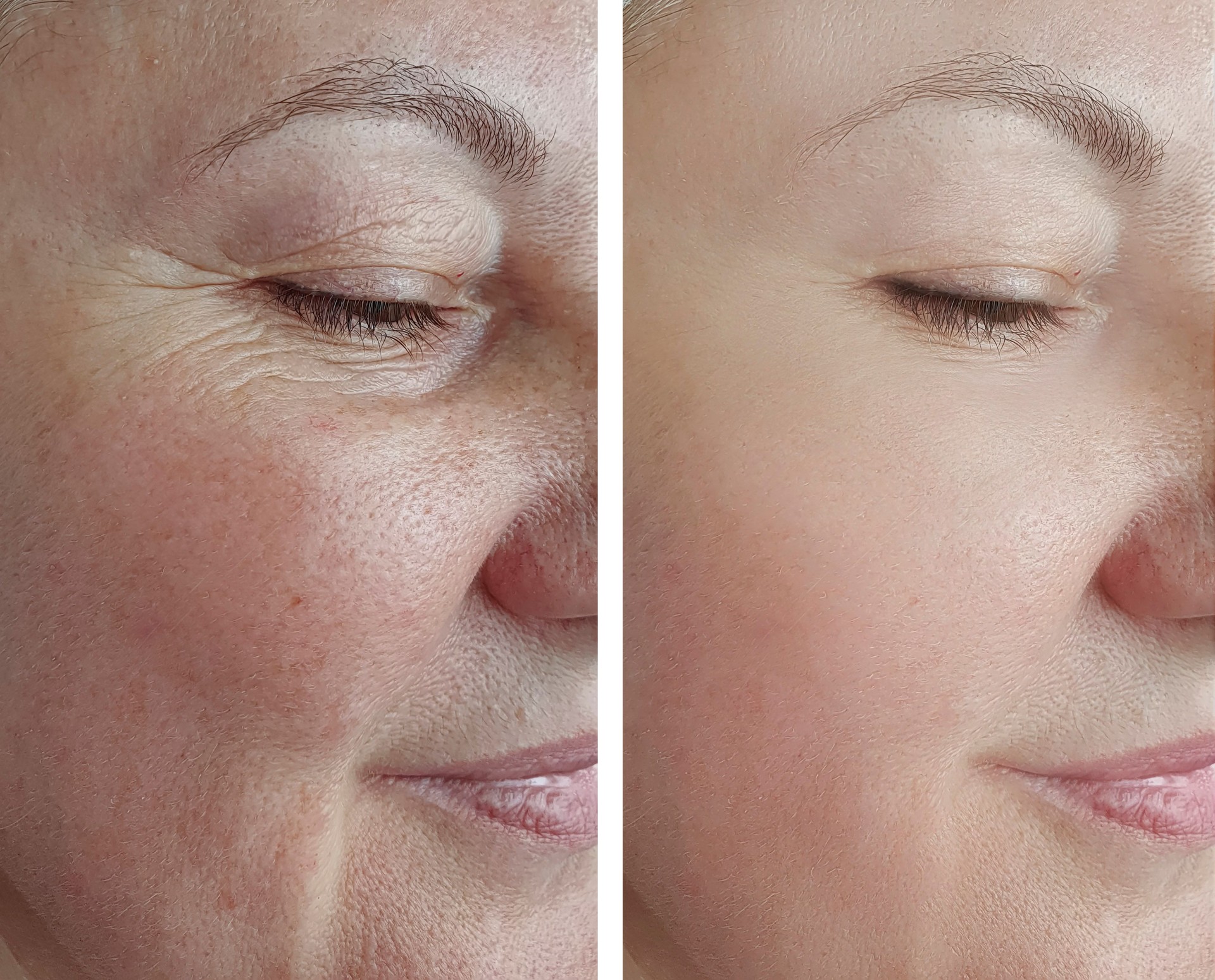 les rides du visage de la femme avant et après la flèche de traitement
