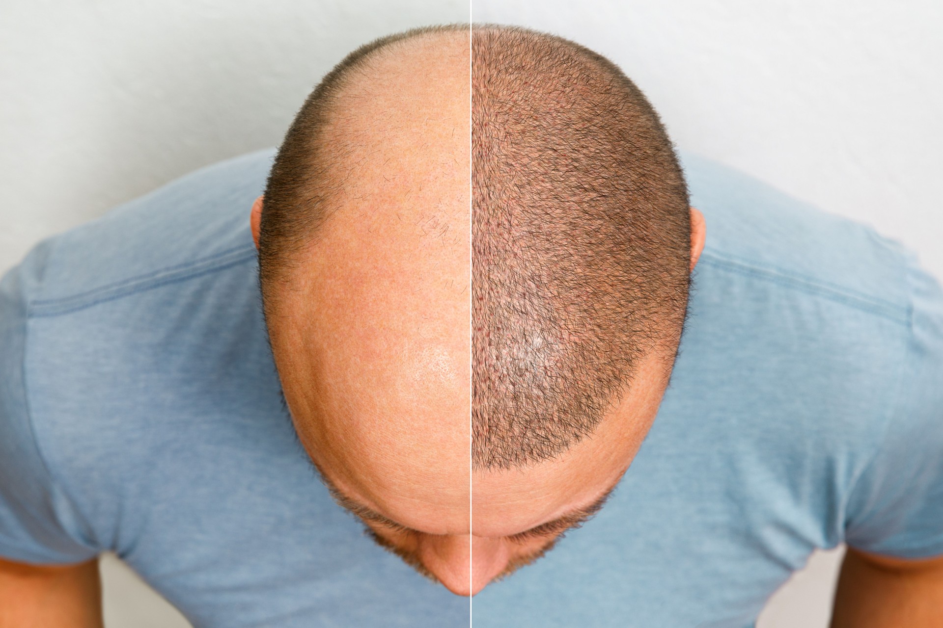 La tête d’un homme chauve avant et après la chirurgie de greffe de cheveux. Un homme qui perd ses cheveux est devenu hirsute. Une affiche publicitaire pour une clinique de greffe de cheveux. Traitement de la calvitie